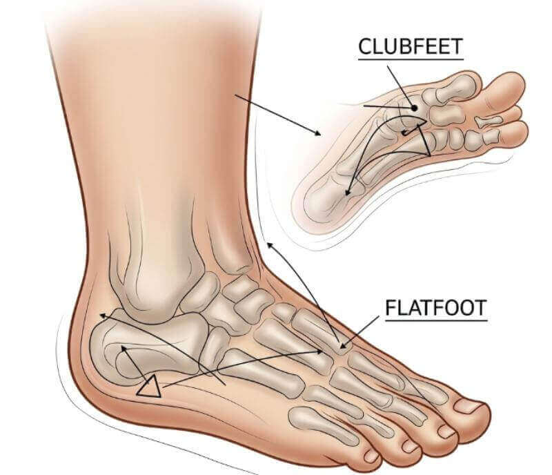 تشوهات القدم عند الأطفال