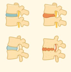 الانزلاق الغضروفي 