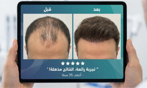 صور قبل وبعد زراعة الشعر