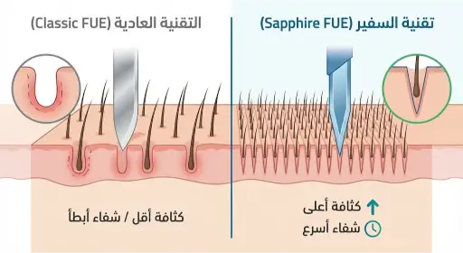 الفرق بين قنوات زراعة الشعر السفير والاقتطاف العادي