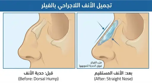 تجميل الأنف بالفيلر قبل وبعد إخفاء العظمة البارزة
