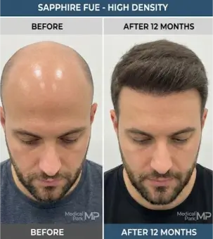 نتائج زراعة الشعر بتقنية السفير قبل وبعد لتغطية مساحات الصلع الكبيرة