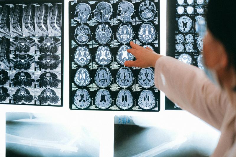 قسم طب الأعصاب في تركيا مستشفيات ميديكال بارك