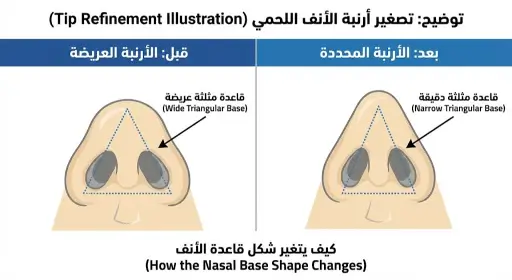 تصغير أرنبة الأنف اللحمي