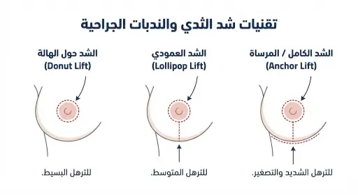 أنواع عمليات شد الثدي وأشكال الندبات الجراحية: الشد الهلالي، العمودي، والمرساة لعلاج الترهل