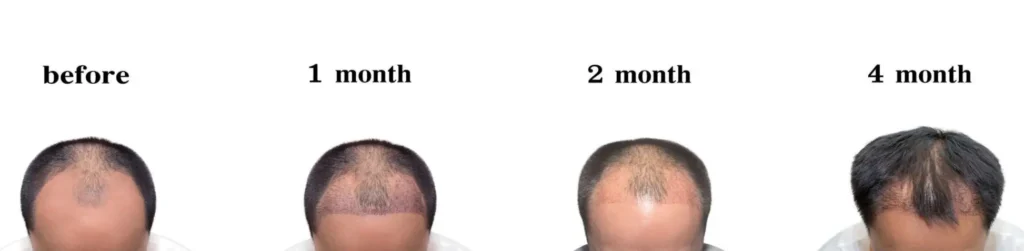 صور قبل وبعد زراعة الشعر في تركيا