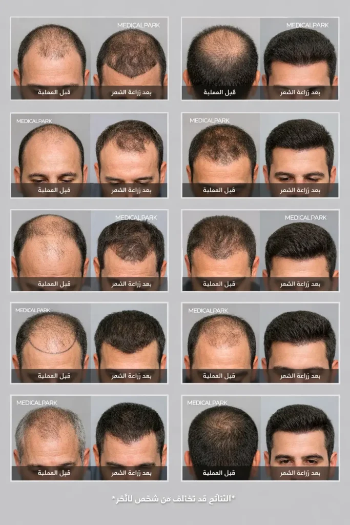 نتائج زراعة الشعر في تركيا قبل وبعد للرجال في مستشفيات ميديكال بارك