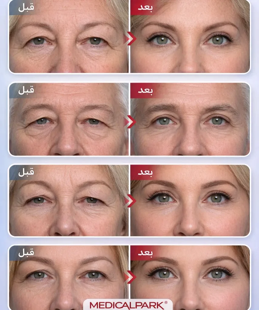 عملية شد الجفون بالصور