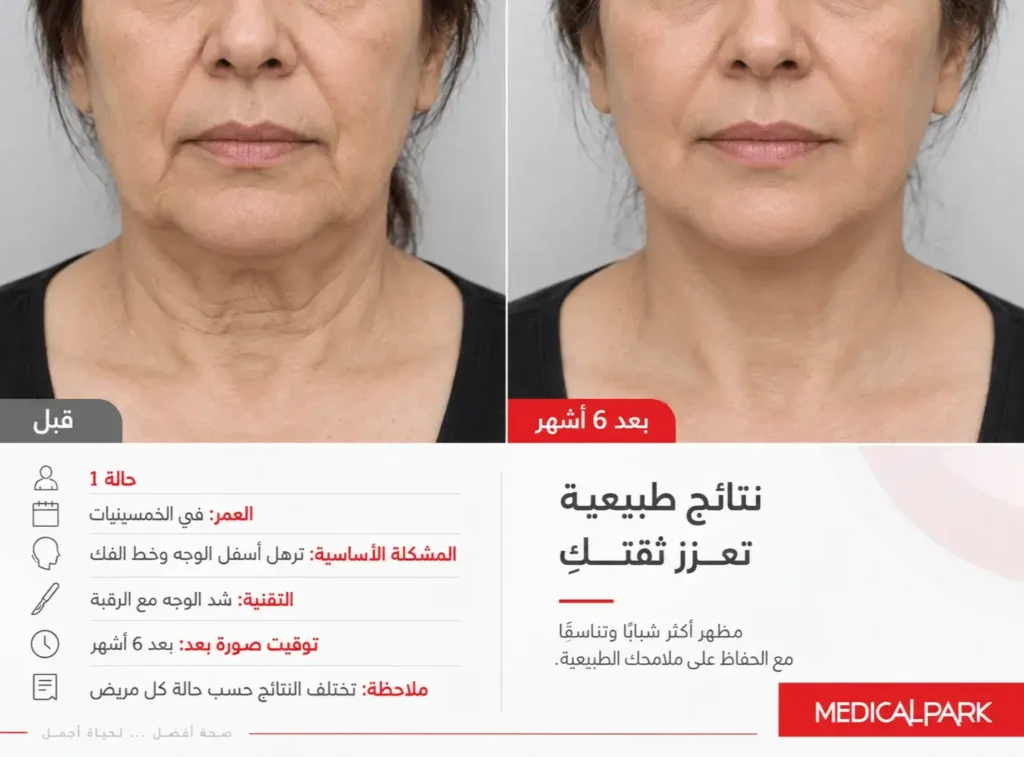 صور قبل وبعد عملية شد الوجه